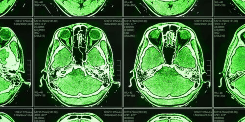 Neurological Scan Enhanced Using Optical Filters