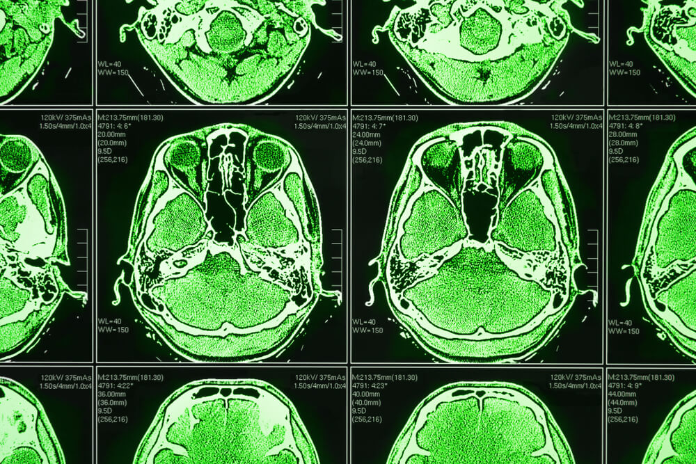 Neurological Scan Enhanced Using Optical Filters